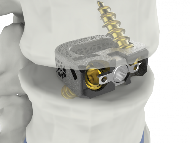 척추 융합기기 ‘유니스페이스(UniSpace® TPLIF Cage, 요추 케이지)’ 미국 FDA 승인 획득