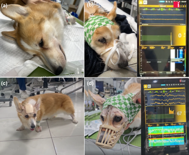 (a) MRI 촬영 전 뇌신경계검사 시 결손 및 멘탈 저하 확인. (b) 뇌파 검사상 뇌파형 관찰되지 않음. (c) 수술 후 1일차에 기립 및 보행이 가능해진 환자의 모습. (d) 뇌파검사에서 정상 범주의 뇌파 패턴이 재출현한 소견